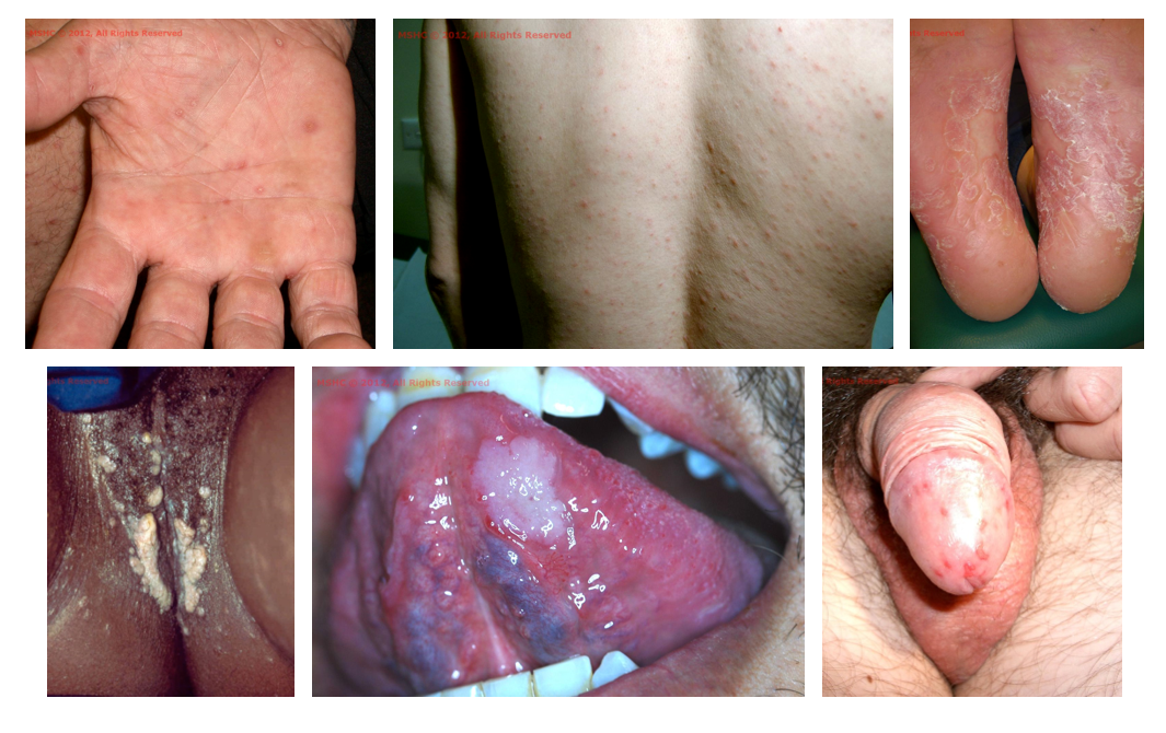 The Clinical Stages Of Syphilis Australia