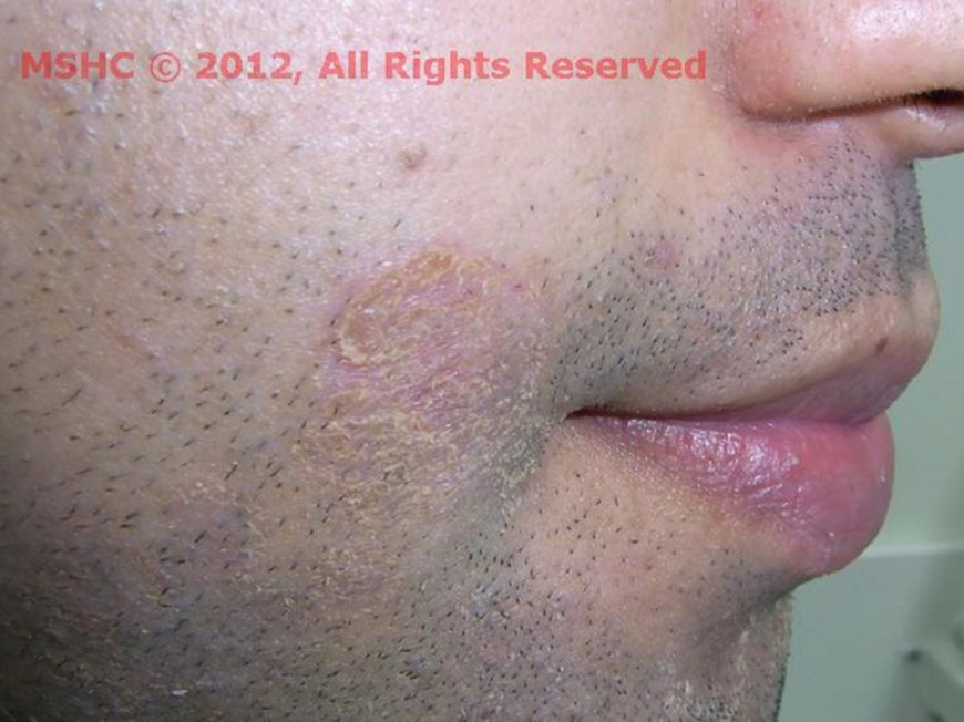 The Clinical Stages of Syphilis | Australia